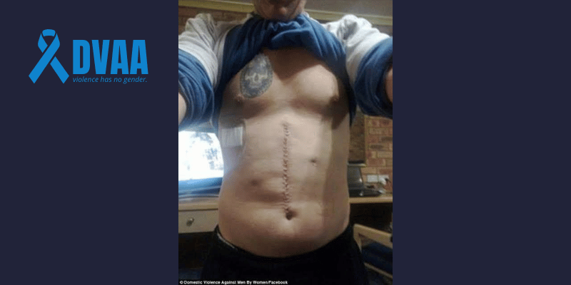 Simon Lanham lifts his shirt to reveal the long vertical surgical scar down the centre of his abdomen — the result of emergency surgery after being stabbed multiple times by his former partner.